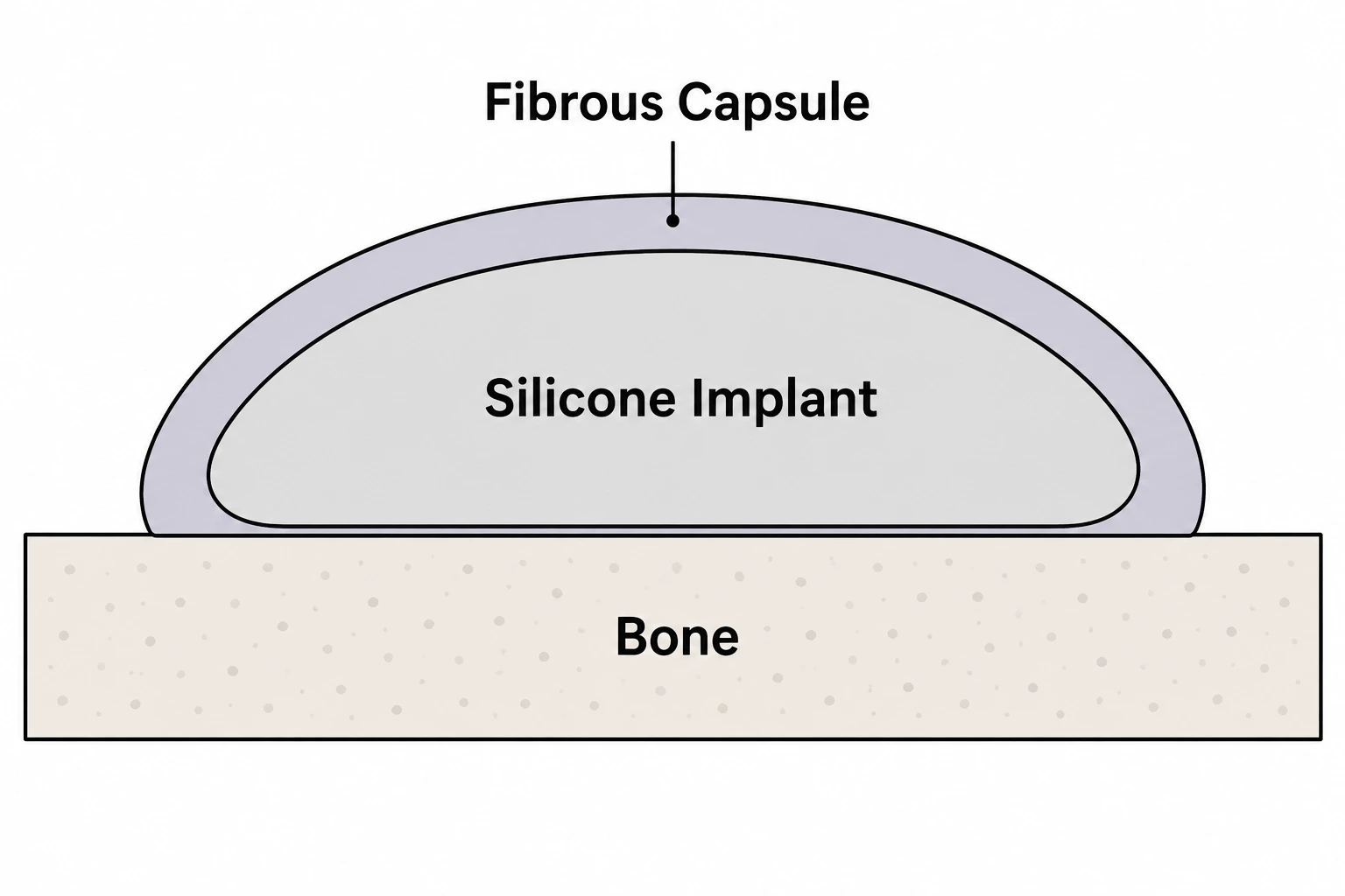 A simple vector diagram showing a cross-section of bone with a smooth silicone implant resting against it. A thick wall of scar tissue (fibrous capsule) completely surrounds the implant, preventing it from attaching to the bone.