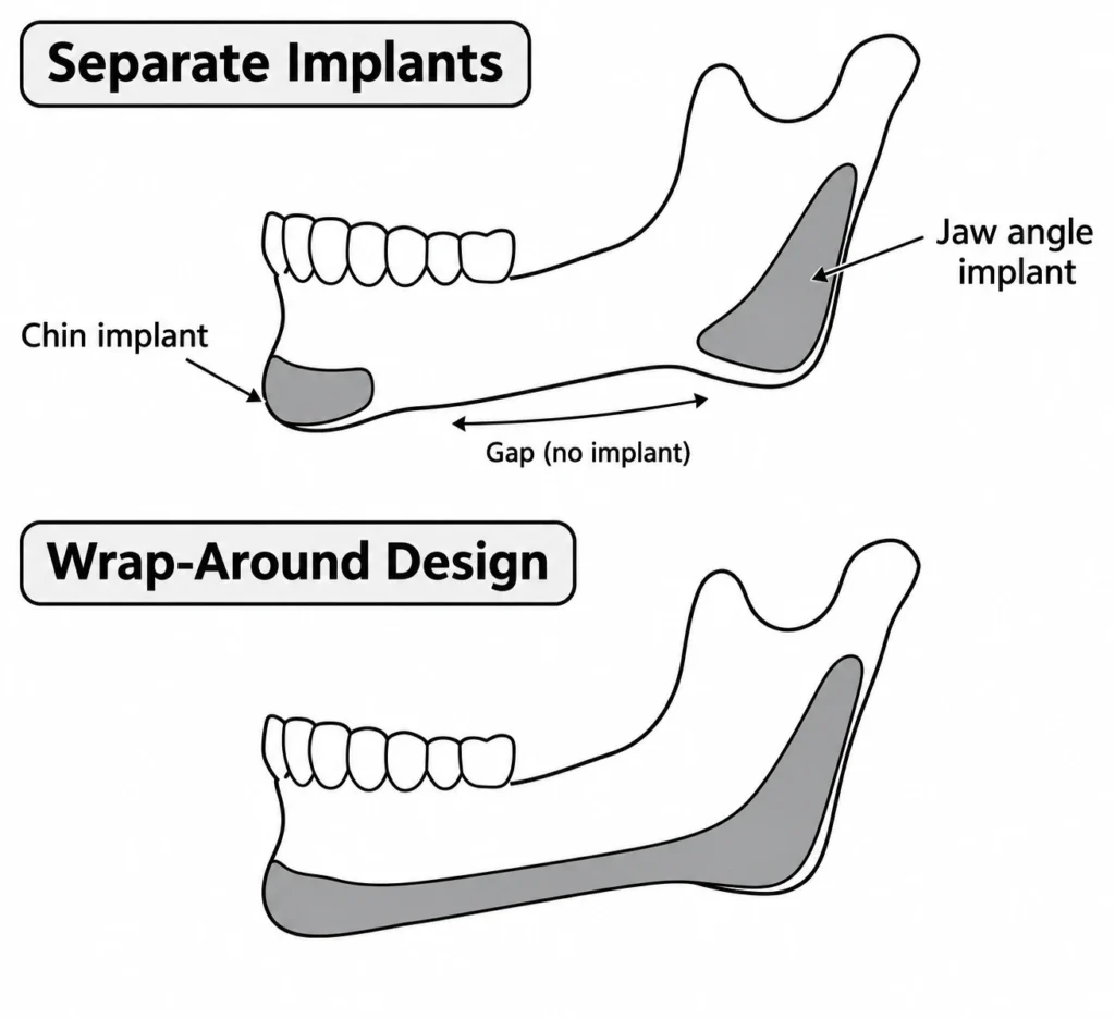 A split vector drawing contrasting separate chin and angle implants with noticeable gaps, versus a continuous wrap around jaw implants with smooth transitions.