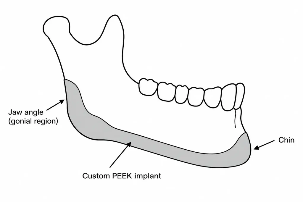 Platte vectorprofielillustratie van een kaakbot met custom peek-gezichtsimplantaten geplaatst over een terugliggende kin en een zwakke kaakhoek.