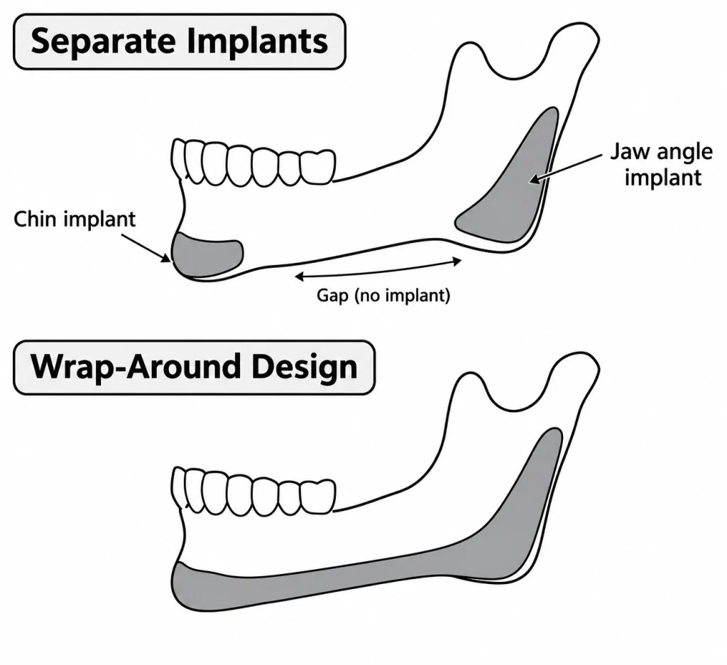 Een gesplitste vectorillustratie die afzonderlijke kin- en kaakhoekimplantaten met duidelijk zichtbare openingen vergelijkt met doorlopende Wrap-around kaakimplantaten met vloeiende overgangen.